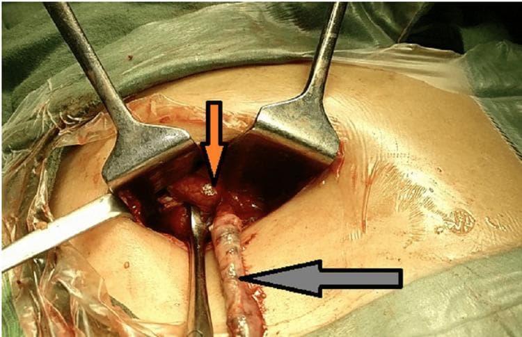 This clinical photograph captures an intraoperative view of an emergency appendicectomy through a McBurney's point incision, revealing a rare anatomical variation: a duplicated vermiform appendix. Two distinct appendices are visible within the surgical field, stabilized by metal retractors. An inferiorly positioned, elongated appendix is indicated by a gray arrow. Located superiorly, an orange arrow points to a second appendix that appears acutely inflamed and gangrenous; a small, pale, firm fecolith is visible near its base. The surrounding tissues exhibit signs of severe inflammation, including marked vascular congestion and erythema. There is visible pooling of glistening seropurulent fluid and pus in the peritoneal cavity, consistent with appendiceal perforation and localized peritonitis. This image serves as a high-level educational resource for surgical residents and medical students, illustrating the clinical presentation of appendiceal duplication and the surgical anatomy of the cecal base during complicated appendicitis.
