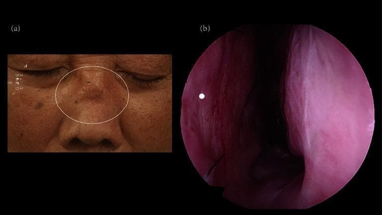 This composite image illustrates clinical and endoscopic findings associated with Granulomatosis with Polyangiitis (GPA). Figure (a) is a clinical photograph of a patient's mid-face featuring a 'saddle nose' deformity, highlighted by a white circle. This deformity is characterized by a visible depression or collapse of the nasal bridge (dorsum) resulting from cartilaginous destruction. The surrounding skin exhibits signs of chronic inflammation and texture changes. Figure (b) presents a 0-degree endoscopic view of the left nasal cavity. The nasal mucosa appears erythematous and slightly irregular. A white dot indicates the post-surgical site of a septal biopsy. Notably, the endoscopic view confirms the absence of a nasal septal perforation following the procedure. These images serve as classic educational examples of the upper respiratory manifestations of vasculitis, specifically GPA, and the importance of endoscopic monitoring to assess structural integrity and mucosal health during diagnosis and management.
