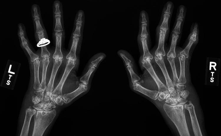 This diagnostic image is a posteroanterior (PA) bilateral hand and wrist X-ray demonstrating advanced erosive arthritis consistent with long-standing rheumatoid arthritis. Key findings include symmetric involvement of the metacarpophalangeal (MCP) joints and carpal bones. There is significant joint space narrowing, periarticular osteopenia, and marginal bone erosions particularly visible at the second and third MCP joints. Structural deformities are evident, characterized by ulnar deviation of the digits at the MCP joints and carpal crowding with secondary osteoarthritic changes in the wrists. A radiopaque ring is visible on the fourth digit of the left hand. The image serves as a clinical example of progression in treatment-resistant inflammatory arthritis, illustrating the irreversible joint destruction and malalignment that occurs in chronic seropositive rheumatoid arthritis.