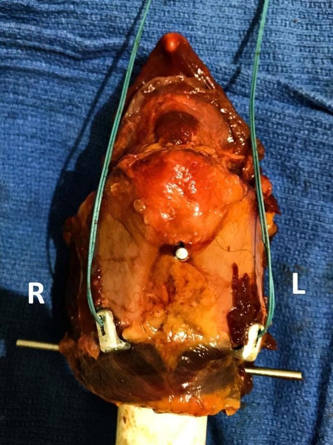 This clinical photograph displays a surgical setup on a harvested larynx to demonstrate the application of custom laryngeal clamps used in laryngoplasty. Two U-shaped stainless steel clamps are positioned bilaterally on the caudoventral margins of the thyroid cartilage laminae, labeled 'R' and 'L' for right and left. Each clamp consists of a short dorsal arm and a long ventral arm, which wrap around the caudal edge of the cartilage. A thick green polyester suture is integrated into each construct. The suture path involves threading through dual holes in the dorsal arm of the clamp, passing through a pre-drilled hole in the thyroid cartilage, and finally through a slit on the clamp's dorsal arm. This arrangement is designed to reinforce the anchorage point on the cartilage, distributing mechanical load to prevent cartilage tearing during laryngoplasty maneuvers. The setup is mounted on a mechanical base for biomechanical testing, illustrating the structural relationship between the prosthetic implants, the suture, and the cartilaginous anatomy.