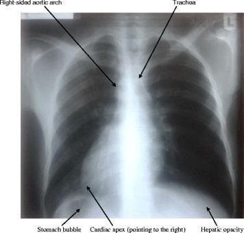 This diagnostic image is a posterior-anterior (PA) view chest X-ray demonstrating situs inversus totalis. The radiograph reveals a complete mirror-image reversal of the thoracic and upper abdominal viscera. Key findings include dextrocardia, where the cardiac apex is oriented toward the right hemithorax, and a right-sided aortic arch. The trachea shows a slight deviation to the left. In the subdiaphragmatic region, the stomach gas bubble (gastric bubble) is abnormally positioned below the right hemidiaphragm, while the hepatic opacity (liver shadow) is located under the left hemidiaphragm. The lung fields appear clear without remarkable pathology. This visual serves as a primary example of situs inversus, an autosomal recessive condition that may be associated with primary ciliary dyskinesia (Kartagener syndrome) when clinical symptoms like chronic sinusitis or bronchiectasis are present.
