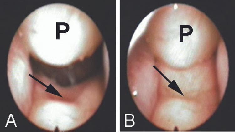 Two preoperative flexible nasopharyngoscopic views (A and B) demonstrating a large nasopharyngeal polypoid mass (labeled 'P') and a submucous cleft palate. In view A (quiet breathing), a significant notch is visible in the midline of the nasopharyngeal surface of the soft palate (indicated by a black arrow), reflecting deficient musculature. The polyp appears as a smooth, rounded, pinkish-fleshy mass originating superiorly and occupying the nasopharyngeal space. In view B (speech articulation), the soft palate elevates, and the polyp appears to fit into the palatal concavity in a 'ball and socket' configuration. This dynamic comparison illustrates the anatomical relationship between a nasopharyngeal obstruction and velopharyngeal insufficiency (VPI). The images highlight key diagnostic features for otolaryngologists and speech pathologists, showing how the physical presence of the polyp may have partially compensated for the hypernasality caused by the notched soft palate.