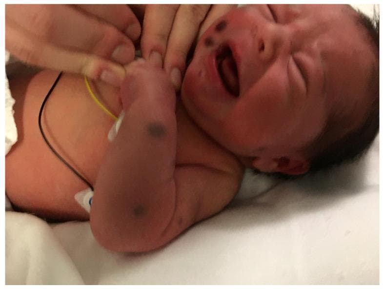 This clinical photograph displays a neonate presenting with a 'blueberry muffin' rash. The image shows multiple discrete, raised, violaceous (bluish-red) nodules and papules. These lesions are distributed across the face, specifically on the right cheek, as well as on the right upper extremity and torso. The nodules appear firm and non-blanching, ranging from a few millimeters to approximately one centimeter in diameter. The infant is shown in a clinical setting with medical monitoring leads visible on the chest. This physical finding is classically associated with extramedullary hematopoiesis (dermal erythropoiesis) and can be a sign of congenital TORCH infections (such as rubella or cytomegalovirus) or systemic neonatal malignancies, including congenital leukemia and metastatic neuroblastoma. The educational focus is on identifying these characteristic cutaneous markers to prompt further diagnostic investigation for serious underlying systemic conditions.