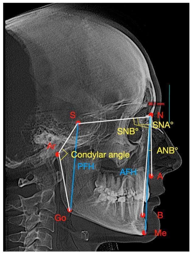 A lateral cephalometric radiograph displaying a standardized orthodontic and maxillofacial tracing used for skeletal analysis. The image identifies key anatomical landmarks marked with red dots, including the Sella (S), Nasion (N), Articulare (Ar), Gonion (Go), Menton (Me), and Points A (Subspinale) and B (Supramentale). White linear tracings connect these points to establish planes for angular measurements. Yellow arcs designate specific skeletal angles: SNA (maxillary position relative to the cranial base), SNB (mandibular position), ANB (intermaxillary relationship), and the condylar angle (S-Ar-Go). Additionally, blue vertical lines represent linear measurements for facial height analysis, specifically Posterior Facial Height (PFH) and Anterior Facial Height (AFH). This diagnostic tool is clinically significant for evaluating sagittal and vertical jaw relationships, planning orthodontic treatment, and assessing craniofacial growth or treatment outcomes in patients with temporomandibular disorders (TMD) or malocclusions.