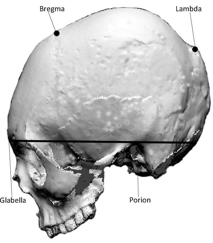 This diagnostic image shows a lateral view of a human skull, reconstructed from a 3D scan, serving as an anatomical diagram for craniometric analysis. Key osteological landmarks are labeled to define the morphology of the cranial vault and base. On the superior aspect of the cranium, the 'Bregma' (the junction of the coronal and sagittal sutures) is identified anteriorly, and the 'Lambda' (the junction of the lambdoid and sagittal sutures) is identified posteriorly. These points help characterize the curvature of the frontal, parietal, and occipital bones. At the base, a straight horizontal reference line is drawn connecting the 'Glabella' (the most prominent point between the eyebrows on the frontal bone) and the 'Porion' (the uppermost point on the margin of the external auditory meatus), extending toward the occipital region. This line serves to demarcate the inferior margin of the cranial vault for quantitative shape analysis. The image is used in clinical imaging and osteological research to assess cranial morphology and variations such as intentional cranial modification.