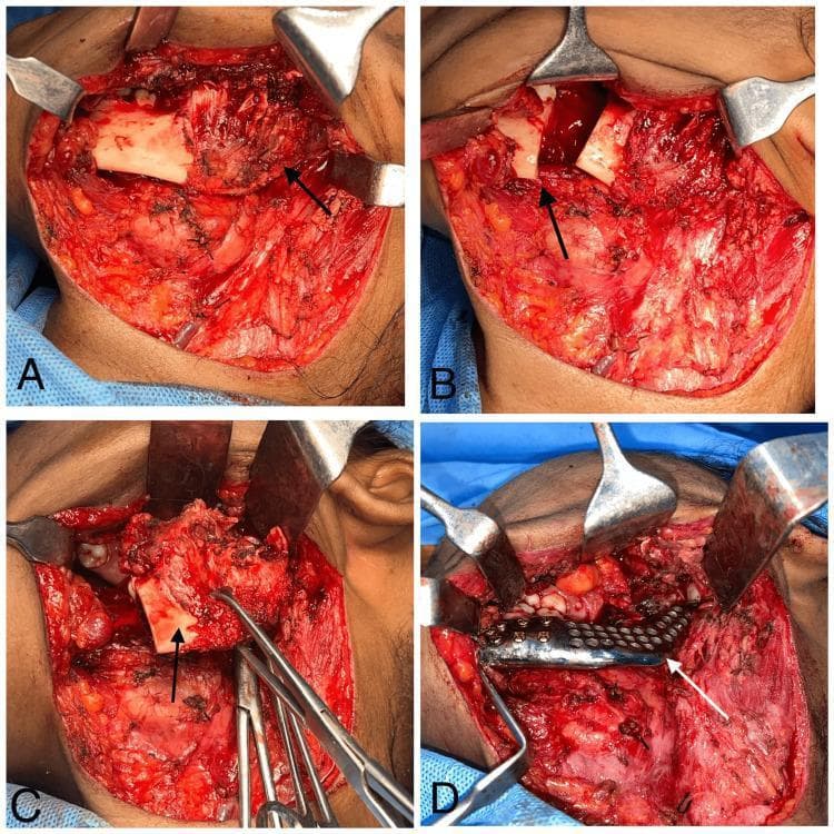 This composite of four clinical photographs (A-D) documents the intraoperative stages of a mandibular reconstruction for unicystic ameloblastoma. Panel A shows the initial surgical field with subplatysmal dissection and elevation of a soft tissue flap to expose the left mandible. Panel B illustrates the segmental mandibulectomy performed distal to the second molar, with arrows indicating the osteotomy site created using an oscillating saw. Panel C displays the excision of the pathology, showing the resected bone segment held by surgical instruments. Panel D demonstrates the reconstruction phase, where a custom-made, patient-specific titanium mesh implant is positioned in the mandibular defect. The implant is secured to the stable bone segments using multiple titanium fixation screws. The series illustrates a radical surgical approach to mandibular lesions, focusing on achieving clear margins and immediate functional reconstruction using CAD-CAM technology to restore facial contour and jaw continuity.