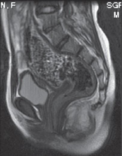 This diagnostic image is a T2-weighted sagittal MRI of the female pediatric pelvis, specifically focusing on the anorectal and urogenital anatomy. The image demonstrates a sagittal view of an 11-year-old patient with an anorectal malformation (ARM). Key anatomical landmarks include the urinary bladder, which is visible anteriorly as a hyperintense (bright), fluid-filled structure. Posterior to the bladder is the rectum, which appears distended with heterogeneous signal intensity, likely representing fecal material. The rectum descends toward the perineum, but its distal termination appears abnormal. The image serves to evaluate the path of an anovestibular fistula (AVF), looking for the communication between the terminal rectum and the vestibule, anterior to the normal anal position. Spinal vertebrae, the sacrum, and pelvic soft tissues provide spatial orientation. This imaging is clinically relevant for surgical planning in cases of delayed presentation of low-type anorectal malformations to assess the level of the rectal pouch and its relationship to the pelvic floor muscles.