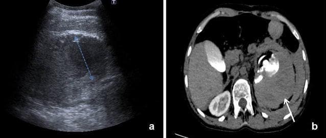 This dual-modality figure presents a comparison of diagnostic imaging for a retroperitoneal hematoma. Image (a) is a retroperitoneal-Extended Focused Assessment with Sonography for Trauma (r-EFAST) ultrasound scan showing a left renal hematoma. The pathology appears as a hypoechoic (dark) fluid collection adjacent to the kidney, with calipers indicating a 6 cm measurement. Image (b) is an axial computed tomography (CT) scan with intravenous contrast of the same patient. The CT confirms a large perirenal hematoma (white arrow) that extends into the pararenal space. Notably, the CT scan demonstrates inhomogeneous contrast distribution within the left renal parenchyma, suggesting compromised perfusion or parenchymal injury. This comparison illustrates the utility of bedside ultrasound in the rapid detection of retroperitoneal bleeding following invasive procedures, while CT provides superior anatomical detail regarding the extent of the hematoma and the functional status of the renal tissue. The clinical focus is on emergency radiology, trauma, and post-procedural complication monitoring for medical students and residents.