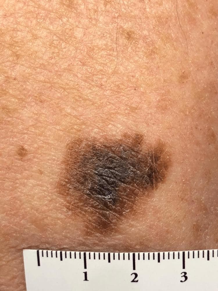 This clinical photograph shows a suspicious pigmented skin lesion on the left arm of an elderly patient, identified as melanoma in situ. The lesion is a large macule with a maximum diameter of approximately 2.5 to 3 cm as indicated by the adjacent metric ruler. It exhibits classic ABCDE features of melanoma, including significant asymmetry and highly irregular, notched borders. The color distribution is heterogeneous, displaying a variegated pattern of dark brown, tan, and focal areas of deep black pigment. The surface texture is uneven with subtle scaling and accentuation of skin markings, but without gross nodularity or ulceration. The surrounding skin shows signs of chronic actinic damage (dermatoheliosis), characterized by solar lentigines and textural changes. This image serves as a high-quality educational example of a primary cutaneous melanoma in its non-invasive stage, highlighting the importance of visual inspection and total skin examination in patients with high cumulative sun exposure.