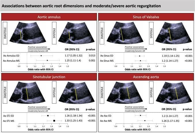 Educational infographic and clinical imaging composite illustrating the associations between aortic root dimensions and moderate/severe aortic regurgitation (AR). The image is divided into four quadrants, each focusing on a specific anatomical region: Aortic Annulus, Sinus of Valsalva, Sinotubular Junction (STJ), and Ascending Aorta.
Each quadrant contains:
1. Diagnostic Images: Side-by-side parasternal long-axis view echocardiograms labeled 'Diastole' and 'Systole.' Yellow calipers (linear markers) demonstrate the internal diameter measurement technique at each specific aortic level.
2. Statistical Forest Plots: Below the echocardiograms, forest plots show the odds ratio (OR) with 95% confidence intervals (CI) for end-diastolic (ED) and mid-systolic (MS) measurements.
Across all four anatomical levels, the odds ratios are consistently >1.0 (ranging from 1.17 to 1.33), indicating a significant positive association where larger aortic root dimensions correlate with a higher risk of moderate/severe AR. The p-values for these associations are consistently <0.05. The data is derived from multivariate logistic regression adjusted for cardiovascular risk factors like hypertension and diabetes.