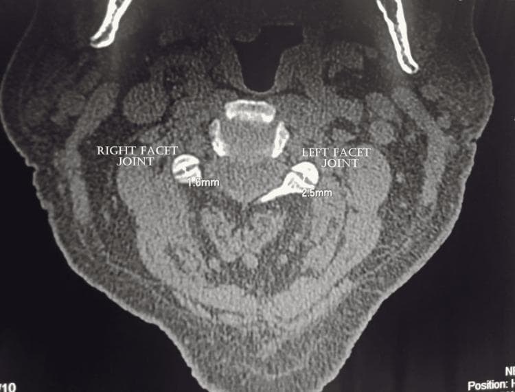 This diagnostic image is an axial Computed Tomography (CT) scan of the cervical spine, displaying the vertebral anatomy and associated soft tissues. Centrally, the vertebral body, spinal canal, and posterior elements including the lamina and spinous process are visible. The focus of the image is the bilateral facet joints (zygapophyseal joints). Annotations show measurement of the joint space width: the right facet joint measures 1.6 mm and the left facet joint measures 2.5 mm. Visually, the right facet joint exhibits signs of degenerative changes, including significant joint space narrowing and the presence of hypertrophic osteophytes. The left facet joint appears relatively more preserved but also shows mild irregularities. Surrounding the bony structures, the paracervical musculature and subcutaneous fat are visualized with varying attenuation. This image serves as an educational example of cervical facet arthropathy and the radiological assessment of spinal degenerative disease, specifically focusing on joint space measurements and osteophyte formation.