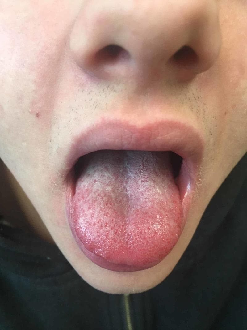 This clinical photograph shows the orofacial region of a patient, demonstrating classic intraoral and perioral signs often associated with scarlet fever or similar streptococcal infections. The primary focus is a 'strawberry tongue' appearance, characterized by an erythematous and inflamed tongue surface with prominent, enlarged fungiform papillae visible as raised red bumps. A white, pseudomembranous exudate (white coating) is present on the dorsal surface, particularly concentrated toward the posterior. Additionally, the image depicts circumoral pallor, where the skin immediately surrounding the mouth, including the upper cutaneous lip, appears noticeably paler in contrast to the surrounding malar erythema. The vermilion border of the lips appears mildly erythematous. This visual material is highly relevant for pediatric medicine and infectious disease specialties, illustrating key diagnostic physical findings used in the clinical identification of toxin-mediated exanthems.