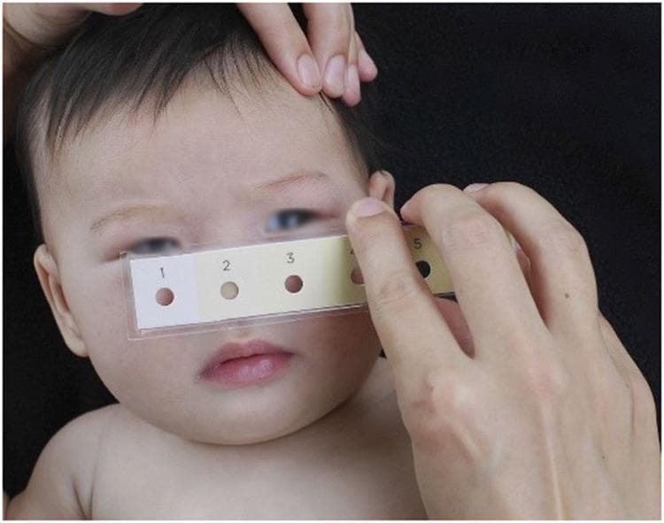Clinical photograph of a neonate undergoing a non-invasive screening for neonatal jaundice (hyperbilirubinemia) using a Bili-ruler. The image shows a healthcare provider holding a rectangular, transparent-sleeved Bili-ruler against the infant's face. The ruler features a standardized color progression strip with six numbered patches (1–6). Each color patch increases in yellow intensity and contains a central circular aperture (hole). These apertures allow the clinician to compare the underlying skin tone directly against the calibrated reference colors to estimate bilirubin levels. The neonate demonstrates visible icterus (yellowish discoloration) of the skin and sclera. This diagnostic tool is designed as a low-cost, point-of-care alternative to electronic transcutaneous bilirubinometers (TcB) and serum testing, following the principle of cephalocaudal progression of jaundice. It is used in clinical settings to determine the need for further laboratory testing, phototherapy, or management of physiological and pathological jaundice.