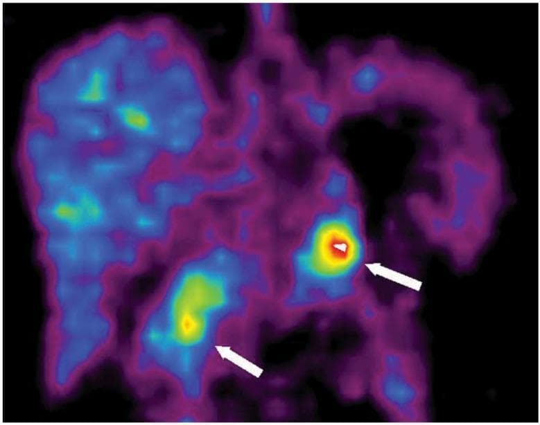 This diagnostic image is a coronal 11C-5-HTP Positron Emission Tomography (PET) scan of the abdomen, specifically illustrating tracer uptake in a patient with Multiple Endocrine Neoplasia type 1 (MEN-1) syndrome. The PET scan utilizes a pseudocolor heatmap where high metabolic activity is indicated by red and yellow, moderate activity by green, and background or low uptake by blue and purple hues. Two distinct focal areas of high radiotracer intensity are identified by white arrows. The arrow on the right points to a localized high-intensity red and yellow signal in the pancreatic head, while the arrow on the left indicates a secondary area of elevated uptake in the pancreatic tail. These findings are characteristic of neuroendocrine tumors (NETs), which typically exhibit high 11C-5-HTP uptake due to increased amine precursor decarboxylation. The liver and surrounding gastrointestinal structures show heterogeneous background tracer distribution. This image serves as a clinical example of PET imaging sensitivity in localizing small pancreatic neuroendocrine tumors that may be occult on traditional CT or MRI.