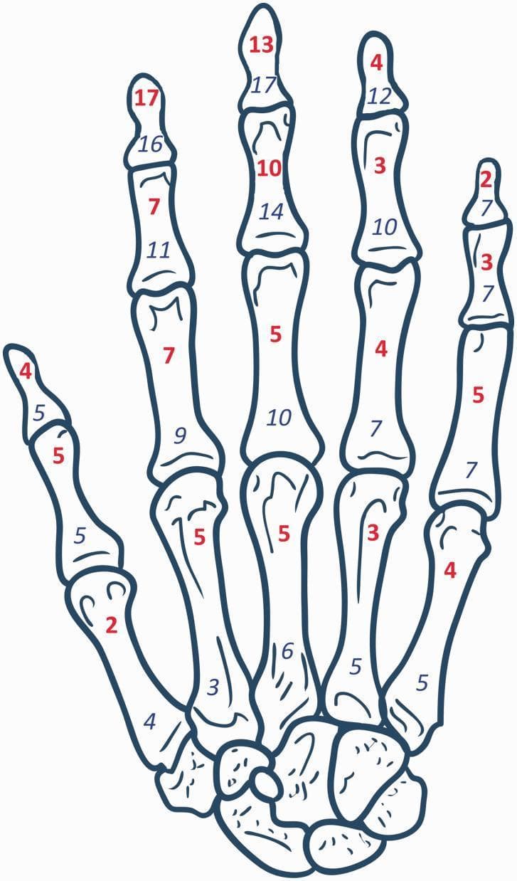 This medical illustration is an anatomical diagram of the human hand skeleton, used for clinical epidemiological mapping. It depicts the dorsal or palmar view of the metacarpals, carpal bones, and phalanges. The diagram functions as a data visualization tool for a cohort study on hand osteomyelitis in patients with digital arterial calcification. Each individual bone—proximal, middle, and distal phalanges, as well as the metacarpals—is overlaid with two sets of numerical data. Numbers in red, bold font represent the incidence of osteomyelitis at that specific anatomical site, while numbers in blue, italic font indicate the frequency of amputation for that bone. Visually, the data shows a higher incidence of pathology in the distal and middle phalanges, particularly of the index and middle fingers. This anatomical map is intended for advanced medical education and orthopedic research to illustrate the distribution of infection and surgical outcomes in high-risk populations, such as those with diabetes mellitus or end-stage renal disease.