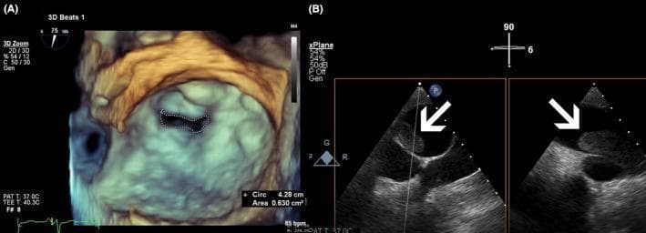 Educational diagnostic imaging compilation showcasing transesophageal echocardiography (TEE) findings in a patient with multi-valvular and vascular pathology. Panel (A) presents a 3D-TEE surgical view of the mitral valve. The image illustrates severe mitral stenosis, characterized by a significantly narrowed, irregular, fish-mouth-shaped orifice. A dotted planimetry line outlines the valve area, with an on-screen measurement of 0.630 cm², confirming a critical reduction in opening. The 3D reconstruction uses a color map of beige, brown, and cyan to provide depth and topographical detail of the valve apparatus. Panel (B) shows a side-by-side X-plane TEE view of the pulmonary artery. White arrows highlight large, echogenic, mobile masses within the proximal right pulmonary artery, diagnostic of pulmonary thromboembolism. The thrombi appear as distinct, heterogeneous structures contrasting against the anechoic blood flow. This composite image is intended for advanced cardiology training, focusing on the integration of 3D and multi-plane TEE for assessing structural heart disease and associated vascular complications like pulmonary hypertension and embolism.