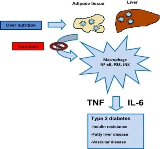 This pathophysiology diagram illustrates the inflammatory signaling pathway linking over-nutrition to metabolic disorders. The process begins with 'Over nutrition' (blue box), which acts upon adipose tissue (yellow lobular illustration) and the liver (brown anatomical representation). These tissues trigger macrophage activation, characterized by the signaling molecules NF-kB, P38, and JNK. The activated macrophages release pro-inflammatory cytokines TNF and IL-6. This inflammatory cascade leads to a clinical outcome box labeled 'Type 2 diabetes,' encompassing insulin resistance, fatty liver disease, and vascular disease. Additionally, the diagram features a therapeutic intervention point where 'curcumin' (red box) is shown with an inhibitory symbol (crossed circle) blocking the signaling pathway from the tissues to the macrophages. This content is relevant for endocrinology and metabolic health education, specifically demonstrating how nutritional excess promotes chronic systemic inflammation and secondary chronic diseases.