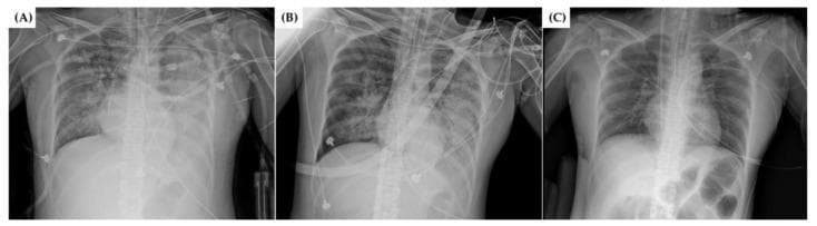This Comparison Chart consists of a series of three anteroposterior (AP) chest radiographs (labeled A, B, and C) illustrating the radiological progression of a patient undergoing Extracorporeal Membrane Oxygenation (ECMO) for Acute Respiratory Distress Syndrome (ARDS). Radiograph (A), taken before ECMO initiation, shows severe, bilateral pulmonary congestion and diffuse, ill-defined opacities consistent with widespread alveolar edema or consolidation. Radiograph (B), taken during ECMO therapy, demonstrates a moderate reduction in pulmonary opacities and improved aeration of the lung fields. Radiograph (C), captured after ECMO weaning, reveals significant resolution of congestion with clearer lung parenchyma, indicating clinical improvement. Visible medical devices throughout the sequence include an endotracheal tube, multiple electrocardiogram (ECG) leads, and various vascular catheters (including potential ECMO cannulae and central venous lines). The series highlights the role of mechanical circulatory support in managing severe hypoxemia and pulmonary edema, providing a visual timeline of lung recruitment and recovery in a critical care setting.
