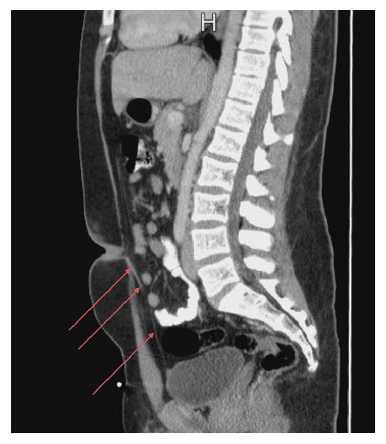 A sagittal view computed tomography (CT) scan of the abdomen and pelvis illustrating the normal anatomy and a specific embryological remnant. The posterior aspect displays the segmented lumbar and sacral vertebral column. Anteriorly, the abdominal cavity contains loops of bowel and the bladder in the pelvic region. Red arrows highlight a thin, linear fibrous band extending from the superior-anterior margin of the urinary bladder toward the umbilicus. This structure is identified as a urachal remnant, representing an obliterated urachus (median umbilical ligament). The surrounding subcutaneous fat and anterior abdominal wall muscles appear normal, with no evidence of associated fluid collections, inflammation, or cystic changes. This diagnostic image is used to teach medical students and radiologists how to identify urachal abnormalities and differentiate them from other abdominal pathologies.