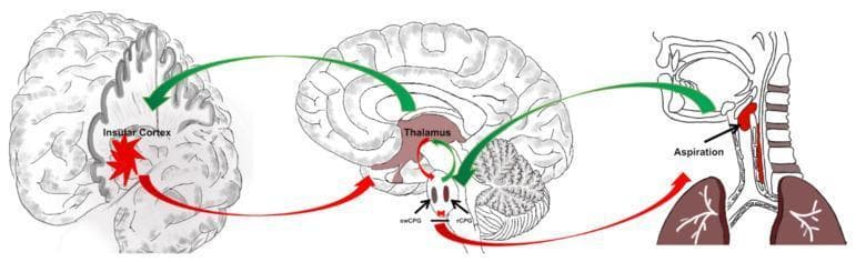This pathophysiology diagram illustrates a hypothesized neurological mechanism for post-stroke dysphagia (PSD) and aspiration following a lesion in the insular cortex. The visual is divided into three sections: a cortical view, a sagittal brain section, and a peripheral anatomical view. The process begins with sensory inputs from peripheral organs (tongue, bronchial, and esophagus) directed via green arrows (promotion) to the brainstem. In the brainstem, the swallowing center pattern generator (swCPG) and respiratory center pattern generator (rCPG) are depicted as adjacent ovals with a red horizontal line indicating reciprocal inhibition. Information flows from the brainstem to the thalamus, which serves as a central relay station, and subsequently to the insular cortex. A red starburst in the insular cortex represents a stroke or disturbance. Red arrows indicate that this cortical damage disrupts the thalamic and brainstem pathways, specifically interfering with the swCPG/rCPG reciprocal inhibition. The final outcome is shown in a cross-sectional view of the throat and lungs, where a red bolus is seen entering the trachea, labeled 'Aspiration,' signifying a failure of airway protection mechanisms.