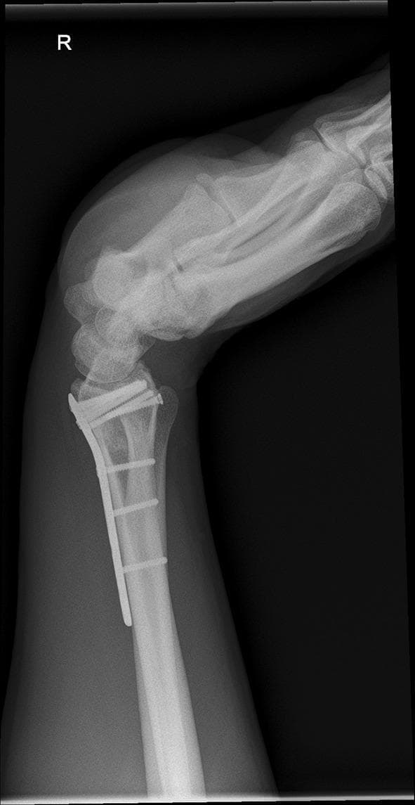 This diagnostic image is a lateral X-ray radiograph of a right wrist in a position of flexion. The image demonstrates a distal radius fracture that has undergone open reduction and internal fixation (ORIF). A volar locking plate is visible along the anterior (volar) aspect of the distal radius, secured with multiple cortical and subchondral locking screws. The screws are positioned near the radiocarpal joint surface to provide stability to the distal fragments. The carpal bones, including the scaphoid and lunate, are visualized in an articulated position with the distal radius, showing a clear flexed orientation. The distal radioulnar joint (DRUJ) and the proximal carpal row are included in the view. There is no evidence of hardware failure, such as plate fracture or screw loosening, and the bone density appears within normal limits. This radiographic view is utilized in orthopedic surgery to assess the range of motion (ROM) and the stability of internal fixation before planned implant removal.