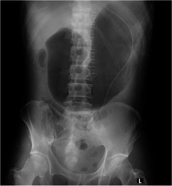 This abdominal radiograph (X-ray) demonstrates significant gastric distention in a postoperative patient. The most prominent feature is a large, radiolucent (air-filled) stomach bubble occupying a substantial portion of the upper abdominal cavity, extending across the midline and down toward the pelvis. A radiopaque nasogastric (NG) tube is visible, entering from the upper aspect of the image and descending along the patient's left side. However, the distal end of the tube appears malpositioned or ineffective, failing to decompress the markedly dilated stomach. Surgical staples are visible along the spine, consistent with recent thoracic or abdominal surgery. The large bowel and small intestinal loops are visible in the lower abdomen but appear non-dilated compared to the massive gastric air. This image illustrates gastric outlet obstruction or severe aerophagia in a clinical setting, highlighting the importance of verifying NG tube positioning and functionality for gastric decompression.