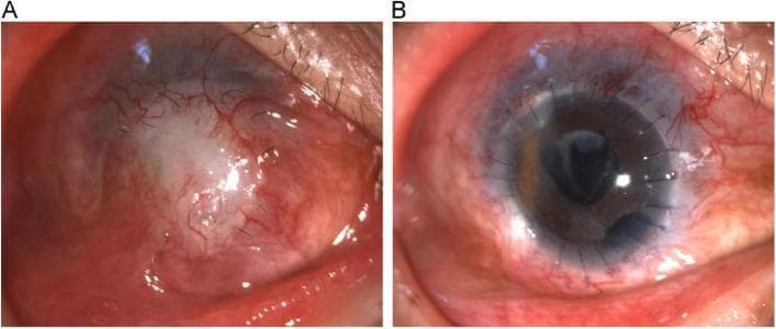 This clinical comparison photograph illustrates the pre- and post-operative status of a secondary corneal transplantation in a human eye. Figure A displays a failed corneal graft six months after an initial penetrating keratoplasty. Key visible pathologies include a dense, whitish central corneal opacity and a pseudo-pterygium—a wing-like fibrovascular growth extending from the conjunctiva onto the corneal surface. Significant conjunctival hyperemia and neovascularization are present, indicating chronic inflammation. Figure B demonstrates the same eye following a second partial penetrating keratoplasty and cataract extraction. The new corneal graft is clear and transparent, allowing for visibility of the underlying iris and pupil. Multiple radial monofilament sutures are visible at the graft-host interface, successfully securing the donor tissue. While some residual perilimbal injection remains, the ocular surface shows marked improvement in clarity and reduced inflammation compared to the pre-operative state. This image set serves as an educational tool for ophthalmology, specifically regarding complications of corneal surgery and the management of graft failure through repeat keratoplasty.