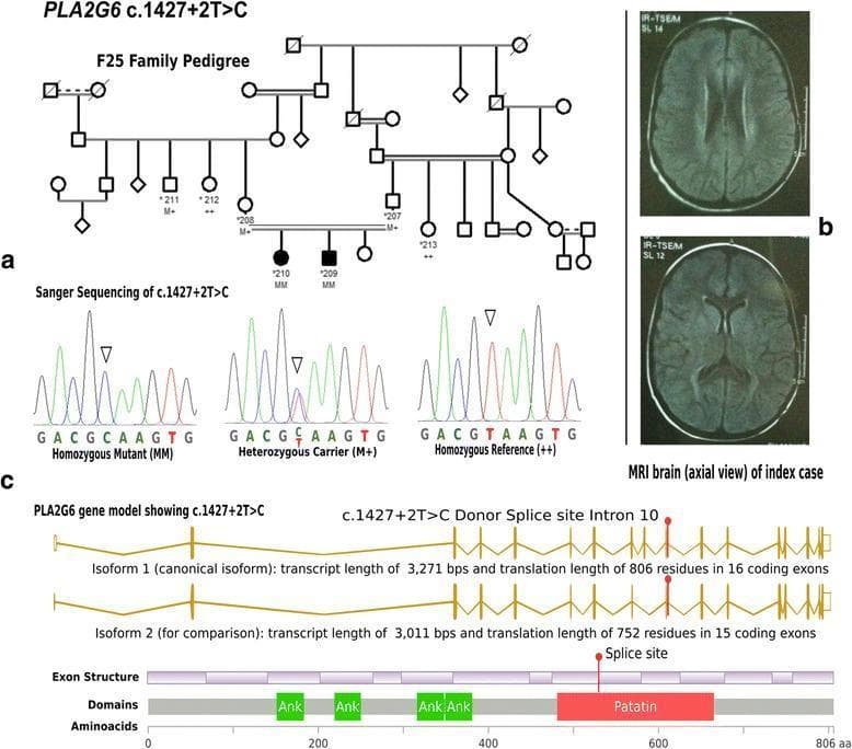 A multi-panel medical infographic detailing the genetic and clinical findings of Infantile Neuroaxonal Dystrophy (INAD) associated with a PLA2G6 mutation. Panel (a) presents a multi-generational pedigree chart (Family F25) demonstrating an autosomal recessive inheritance pattern. Affected individuals (represented by solid black symbols) correspond to the homozygous mutant (MM) genotype, while unaffected parents are heterozygous carriers (M+). Panel (b) displays two axial T2-weighted/FLAIR brain MRI slices of an index patient, showing bilateral, symmetrical hyperintense signal changes in the periventricular white matter, basal ganglia, and globus pallidus. Panel (c) includes Sanger sequencing chromatograms comparing homozygous mutant, heterozygous carrier, and homozygous reference genotypes at the c.1427+2T>C donor splice site. The bottom section provides a PLA2G6 gene model and protein domain map, illustrating the mutation's location at the intron 10 splice site relative to the Ankyrin (Ank) repeats and the Patatin-like phospholipase domain. The visual serves to correlate molecular genetics with neuroradiological manifestations in neurodegenerative disorders.