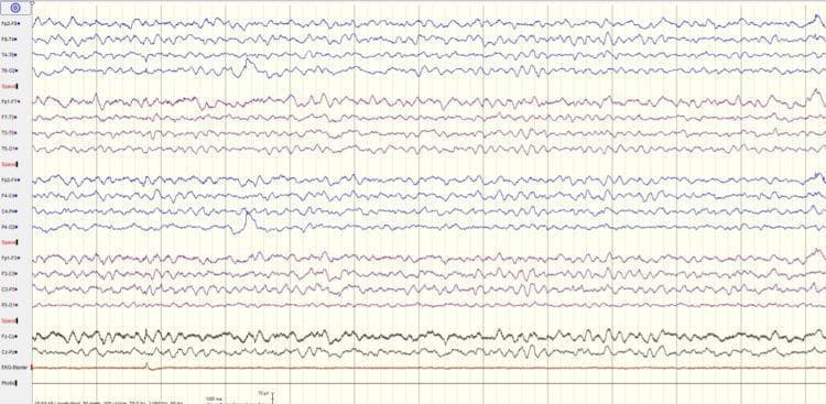 This diagnostic image shows a multi-channel electroencephalogram (EEG) recording, utilized in clinical neurology for assessing brain electrical activity. The tracing demonstrates a bipolar montage across frontal, temporal, parietal, and occipital derivations. A prominent finding is a generalized, rhythmic theta-frequency background of approximately 6 Hz, particularly visible in the posterior channels. This slowing of the normal alpha rhythm represents moderate diffuse encephalopathy, a common finding in metabolic, toxic, or infectious central nervous system disorders. The waveforms are generally sinusoidal but show some irregularity in amplitude and frequency, indicating synchronization across different cortical regions. Critically, there is an absence of epileptiform activity such as spikes, sharp waves, or pleomorphic discharges. A bottom channel labeled as EKG is included for artifact identification, showing relatively flat activity with minimal cardiac signal interference. This EEG is characteristic of an encephalopathic state where basic brain function is altered without focal neurological deficits or active seizure activity.