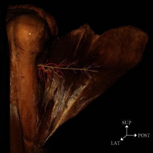 This clinical anatomical photograph displays a deep dissection of a left shoulder from a posterior-lateral perspective, illustrating the neurovascular supply to the deltoid muscle. The head of the humerus is visible superiorly (marked with an asterisk). The dissection reveals the axillary nerve and the posterior circumflex humeral artery (PCHA) emerging through the quadrangular space to traverse the medial surface of the deltoid. For educational clarity, the axillary nerve is color-coded yellow and sits superior to the PCHA, which is color-coded red. Both structures exhibit a horizontal branching pattern across the striated muscle fibers. Orientation indicators (SUP: superior, LAT: lateral, POST: posterior) are provided to establish the spatial context of the surgical neck region. This image serves as a high-fidelity anatomical reference for understanding the spatial relationships and branching density of neurovascular structures during orthopedic or surgical approaches to the humerus and shoulder joint.