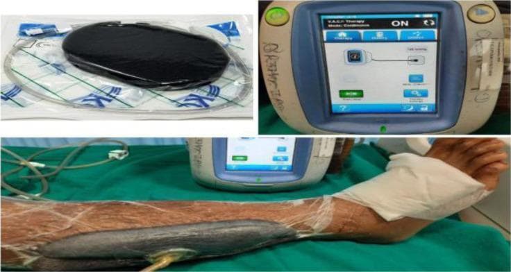 This composite clinical and procedural image illustrates the components and clinical application of a Vacuum-Assisted Closure (VAC) system for negative pressure wound therapy (NPWT). The top-left panel shows the sterile packaging of the premanufactured black polyurethane foam sponge and associated connecting tubing. The top-right panel focuses on the VAC therapy unit's digital interface, displaying an active 'ON' status with a continuous therapy setting of 125 mm Hg, featuring a schematic diagram of the dressing connection. The bottom panel demonstrates the clinical application on a patient's lower leg. A contoured black foam dressing is placed over the wound bed and hermetically sealed with a transparent adhesive drape that extends to the surrounding periwound skin. An evacuation tube is seen emerging from the center of the dressing, connected via a T.R.A.C. pad or similar interface to the vacuum unit. This setup is used in orthopedic and vascular surgery to promote granulation tissue formation, reduce edema, and manage wound exudate in complex or chronic wounds.
