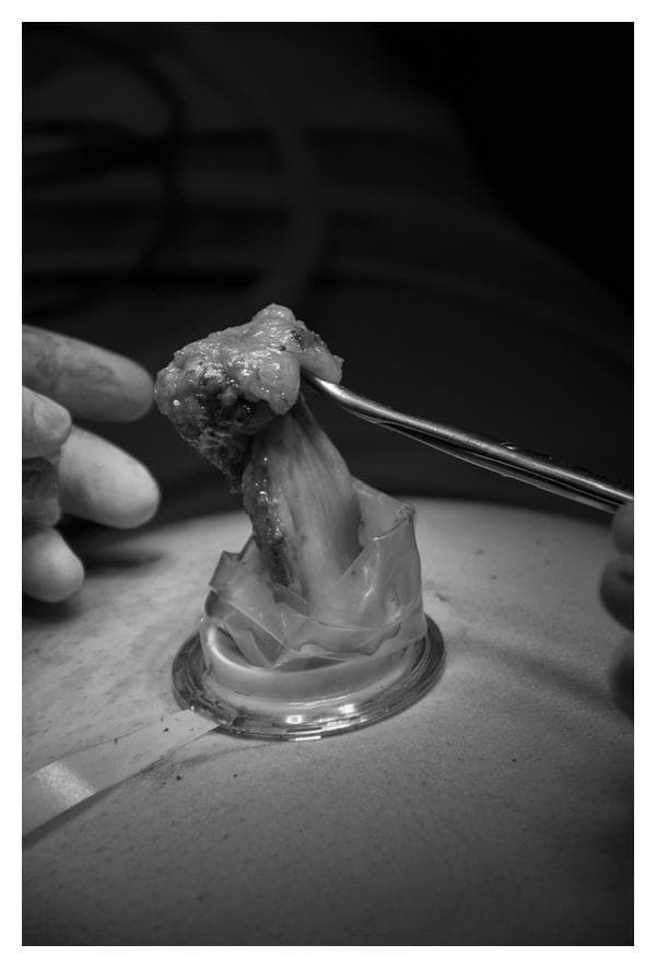 A grayscale clinical photograph documenting a Single-Port Laparoscopic Cholecystectomy (SPLC). The image captures the intraoperative moment of specimen extraction through the umbilicus. A TriPort (Olympus) surgical access device is positioned within a transumbilical incision, featuring a circular rigid base on the skin surface and a clear, flexible silicone or plastic sheath extending upward. A biological specimen, identified as the gallbladder, is being manually extracted through the lumen of the port. The tissue appears elongated and nodular with varied surface texture and density as it is pulled upward. A metallic surgical grasper or forceps is seen at the top of the frame, securely holding the superior portion of the gallbladder during removal. This visual illustrates a key step in minimally invasive surgery where the specimen is retrieved without the use of an endobag, highlighting the functionality of single-incision laparoscopic ports for tissue management.