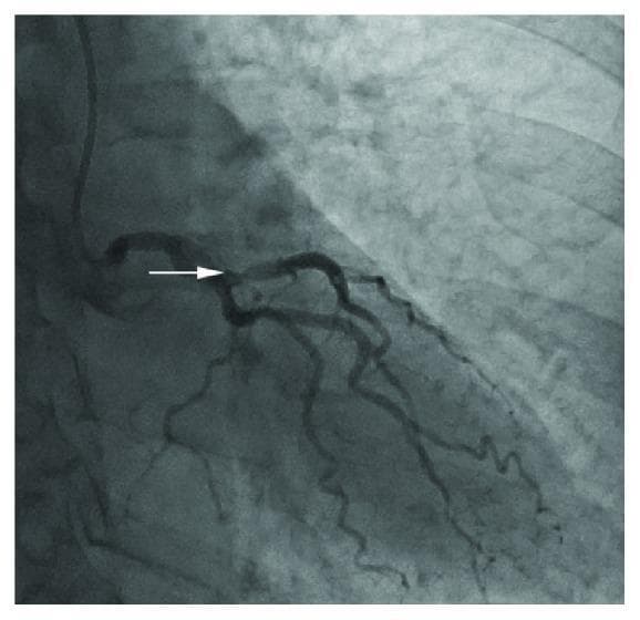 This diagnostic image is a coronary angiogram (X-ray radiography with contrast) focusing on the left coronary artery system. The visual content demonstrates the left main coronary artery branching into the left anterior descending (LAD) and the circumflex (LCx) arteries. A white arrow points specifically to a focal, moderate stenosis located in the mid-segment of the left anterior descending artery. The stenosis is characterized by a visible reduction in the vessel's luminal diameter compared to the proximal and distal segments. The distal coronary flow appears preserved beyond the lesion. The image is useful for medical education in cardiology and interventional radiology to demonstrate common sites of atherosclerotic narrowing and the visual assessment of coronary artery disease. The surrounding pulmonary vasculature and ribs are faintly visible in the background, providing anatomical orientation within the thoracic cavity.