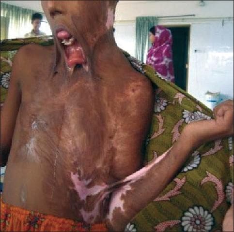 This clinical photograph displays severe, chronic post-burn complications in a pediatric or adolescent patient. The image shows extensive hypertrophic scarring and tissue contracture affecting the face, neck, and upper torso. Notable features include a severe neck contracture that has pulled the chin downward toward the chest, resulting in a marked mandibular deformity and persistent open-mouth posture (ectropion of the lower lip). The oral cavity exhibits significant distortion with dental malocclusion and a protruding tongue, likely exacerbated by soft tissue traction. The skin across the anterior chest and neck is characterized by irregular texture, areas of both hyperpigmentation and hypopigmentation (depigmentation), and dense fibrous bands. A web-like contracture is also visible in the left axillary and antecubital region, significantly restricting the range of motion. This image illustrates the long-term sequelae of inadequately managed severe burns, highlighting the critical need for early anti-contracture positioning, splinting, and surgical reconstruction in burn rehabilitation.