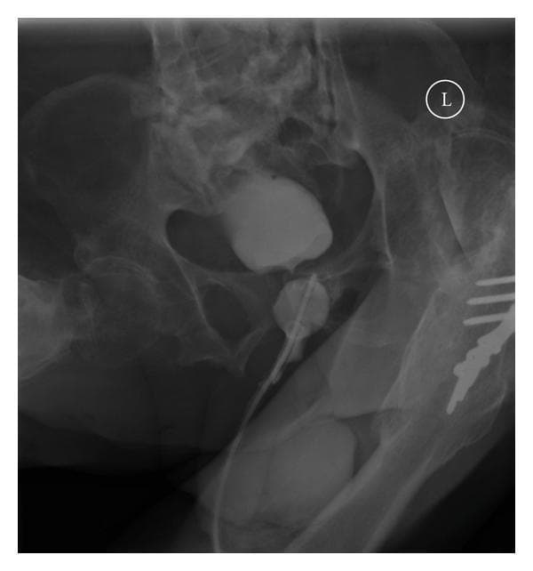 This diagnostic X-ray (cystogram) of the pelvis illustrates a complication of urethral catheterization in a patient with paraplegia. The radiograph shows the urinary bladder filled with radiopaque contrast media, appearing small in capacity. Crucially, the Foley catheter's balloon, also inflated with contrast for visualization, is clearly positioned within the proximal urethra rather than inside the bladder lumen. The catheter tip appears to extend beyond the balloon but remains outside the main bladder cavity. The surrounding pelvic anatomy is visible, including the iliac bones, sacrum, and pubic symphysis, providing a frame of reference for the malpositioned balloon. Surgical hardware, likely orthopedic plates and screws, is visible on the right side of the pelvic girdle. A laterality marker 'L' is present in the upper right quadrant. This image serves as a clinical example of urethral malpositioning of an indwelling catheter, a risk in patients with small-capacity bladders or anatomical abnormalities like false passages.