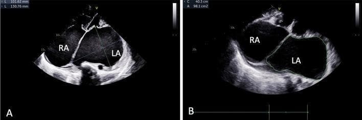 Two-panel echocardiogram demonstrating a case of extreme left atrial enlargement, often referred to as a 'giant left atrium.' Panel A shows a two-dimensional echocardiography view in which the left atrium (LA) and right atrium (RA) are markedly dilated. Linear measurements of the LA are provided, showing dimensions of 130.76 mm and 101.62 mm. Panel B displays the planimetric measurement of the left atrium, where the chamber is outlined with a dotted line, yielding a cross-sectional area of 98.1 cm². The image highlights the morphological impact of chronic rheumatic heart disease, specifically severe mitral valve disease, which typically drives such extreme chamber remodeling. The interatrial septum and adjacent RA are also visible, though the LA disproportionately occupies the cardiac silhouette. These images serve as a classic clinical example of advanced atrial cardiopathy and the quantitative assessment of chamber size using standard echocardiographic parameters.