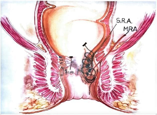 This medical illustration depicts a coronal cross-section of the rectum and anal canal, demonstrating the anatomical landmarks and surgical technique for a Transanal Hemorrhoidal Dearterialization (THD) 'Anolift' procedure. The diagram highlights the internal and external anal sphincters, the rectal mucosa, and key vascular structures including the Superior Rectal Artery (S.R.A.) and Middle Rectal Artery (M.R.A.). On the right side of the illustration, a hemorrhoidal prolapse is shown being addressed with a surgical suture. The suture is anchored superiorly with a locking button and continues as a running plication through the mucosa and submucosa, stopping proximal to the dentate line. This visualizes the mechanism of mucopexy, where the prolapsed tissue is lifted and repositioned proximally by tightening the suture to create a concertina effect on the rectal wall. A scale marker of 1 cm is provided near the anal transition zone for spatial orientation. This diagram is intended for surgical education regarding the management of Grade III and IV internal hemorrhoids.