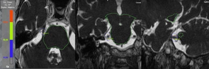 Diagnostic diagnostic image showing a Stereotactic Radiosurgery (SRS) treatment plan for refractory right trigeminal neuralgia in axial, coronal, and sagittal planes. The imaging modality is MRI-based planning software. The primary anatomical focus is the Trigeminal Nerve Root (TNR) at its exit from the lateral pons (brainstem) toward Meckel's cave. Key contours include the brainstem outlined in green and the TNR target contoured in red. Superimposed on the anatomy are dose distribution curves (isodose lines): the 40 Gy isodose line (50% of the prescription dose) is shown in light green, encompassing the TNR, while the 16 Gy isodose line is shown in blue, demonstrating the steep dose gradient designed to spare the adjacent brainstem (Organs at Risk). A plus sign indicates the treatment isocenter. This visual illustrates the clinical application of high-precision radiation oncology to target small cranial nerves while maintaining a maximum brainstem dose below 16 Gy, optimizing the therapeutic ratio for pain relief while avoiding neurological deficits.