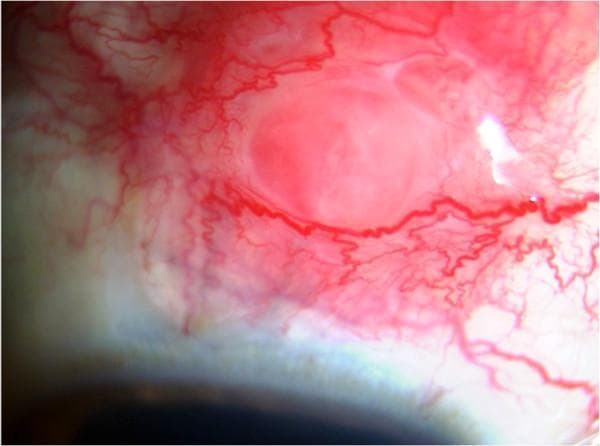 This clinical photograph, captured via slit-lamp biomicroscopy, illustrates a focal scleral nodule in a patient with systemic sarcoidosis. The image focuses on the anterior segment of the eye, specifically the bulbar conjunctiva and underlying sclera. The primary feature is a well-circumscribed, elevated, pinkish-red nodular mass. Surrounding the lesion is intense episcleral and conjunctival injection, characterized by dilated, tortuous blood vessels radiating towards the nodule, indicating significant localized inflammation and vascular engorgement. The central portion of the nodule appears slightly paler than its hyperemic periphery. This finding represents a rare ocular manifestation of sarcoidosis, showcasing granulomatous infiltration of the sclera. Key educational concepts include the identification of inflammatory scleral lesions, differentiating episcleritis from nodular scleritis, and recognizing ocular markers of systemic granulomatous diseases. The image is a valuable diagnostic reference for ophthalmologists and rheumatologists managing multi-system inflammatory conditions.