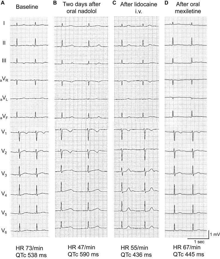 This Comparison Chart displays a 12-lead electrocardiogram (ECG) series from a patient with Long QT Syndrome Type 2 (LQT2), demonstrating the pharmacological effects of different agents on cardiac repolarization. The image is divided into four panels (A-D) representing sequential clinical states. Panel A (Baseline) shows a heart rate (HR) of 73 bpm and a markedly prolonged QTc of 538 ms, with notched T-waves characteristic of LQT2. Panel B (Two days after oral nadolol) illustrates drug-induced bradycardia (HR 47 bpm) and further QTc prolongation to 590 ms, highlighting the risk of beta-blocker-induced bradycardia in certain LQT2 phenotypes. Panel C (After lidocaine i.v.) shows a dramatic shortening of the QTc to 436 ms, demonstrating the efficacy of Class Ib antiarrhythmic agents in blocking late sodium currents (INaL). Panel D (After oral mexiletine) confirms a sustained near-normal QTc of 445 ms at a HR of 67 bpm. This visual sequence serves as an educational tool for identifying LQT2 morphology, understanding the Bazett-corrected QT interval relationship with heart rate, and evaluating the paradoxical response to beta-blockers versus the therapeutic benefit of sodium channel blockers.