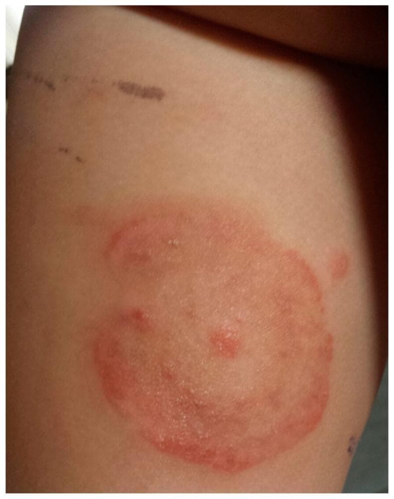 This clinical photograph displays a dermatological presentation of tinea corporis (ringworm) in a pediatric patient. The primary feature is an annular, erythematous plaque located on the trunk or proximal limb. The lesion is characterized by a well-demarcated, raised red border with evidence of mild scaling or vesiculation, indicating active peripheral growth. The center of the plaque shows partial clearing with a lighter pink hue, though it remains occupied by a few scattered inflammatory papules. Above the primary lesion, incidental linear hyperpigmented marks are visible, likely representing excoriations or minor superficial trauma. The image serves as a classic educational example of a fungal skin infection, specifically demonstrating the centrifugal spread and central clearing characteristic of Microsporum canis dermatophytosis.