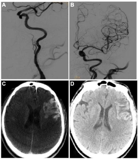 This composite image presents a clinical case of endovascular treatment for stroke and its subsequent complications. Panels A and B are Digital Subtraction Angiography (DSA) images of the left internal carotid artery (ICA). Panel A demonstrates a long-segment occlusion of the ICA characterized by a abrupt cessation of contrast flow. Panel B shows the same vessel post-recanalization after the deployment of two endovascular stents, revealing restored patency and distal intracranial filling. Panels C and D are axial CT scans of the brain at the level of the lateral ventricles. Panel C (Xper CT) was obtained immediately post-procedure and shows a large, sheet-like hyperdense area in the left hemisphere, occupying over 30% of the infarcted territory, consistent with a Type III hemorrhagic transformation or contrast extravasation. Panel D is a non-contrast CT plain scan from the following day, showing the persistence of this hyperdense lesion with a slight reduction in density, confirming the diagnosis of hemorrhagic transformation within the ischemic stroke zone. The image illustrates the successful technical outcome of endovascular recanalization and the serious potential complication of reperfusion-related hemorrhage.