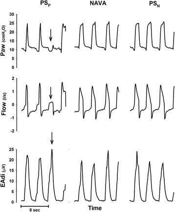 This physiological tracing compares three mechanical ventilation modes in a human patient: pneumatically triggered pressure support (PSP), neurally adjusted ventilatory assist (NAVA), and neurally controlled pressure support (PSN). The data is organized in a 3x3 grid across columns (modes) and rows (parameters). The vertical axes measure airway pressure (Paw in cmH2O), respiratory flow (l/s), and electrical activity of the diaphragm (EAdi in ฮผV) as a function of time. In the PSP column, an arrow identifies an 'ineffective effort' where a significant spike in EAdi (diaphragmatic contraction) fails to trigger a corresponding ventilator-supported airway pressure rise, demonstrating patient-ventilator asynchrony. In contrast, the NAVA and PSN columns show improved synchrony, where neural signals (EAdi) directly correlate with the onset of pressure delivery. PSN shows a more rapid pressurization profile compared to the proportional ramp-up seen in NAVA. This comparison illustrates how neural-based triggering and control mechanisms can mitigate triggering delays and missed efforts common in traditional pneumatic pressure support.