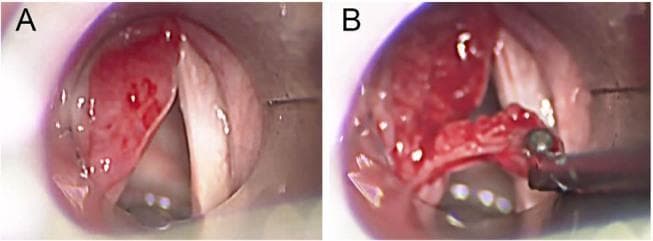 A side-by-side comparison of intraoperative microlaryngoscopy images demonstrating the management of a laryngeal mass. Panel A displays a preoperative view of the glottis featuring a prominent, erythematous, subepithelial mass located on the left false vocal cord. The lesion is reddish-pink with visible superficial vascularity or punctate spots and extends toward the laryngeal ventricle, partially obscuring the true vocal cord and narrowing the laryngeal airway. Panel B illustrates the intraoperative stage during surgical excision using the cold steel technique. A surgical grasper is seen retracting a portion of the friable, reddish tissue as it is being removed from the underlying laryngeal structures. The visual differences between the panels highlight the reduction of the neoformation, which was histologically confirmed as localized laryngeal amyloidosis. The images serve as an educational reference for Otolaryngology (ENT) regarding the endoscopic appearance and surgical debulking of benign laryngeal tumors.