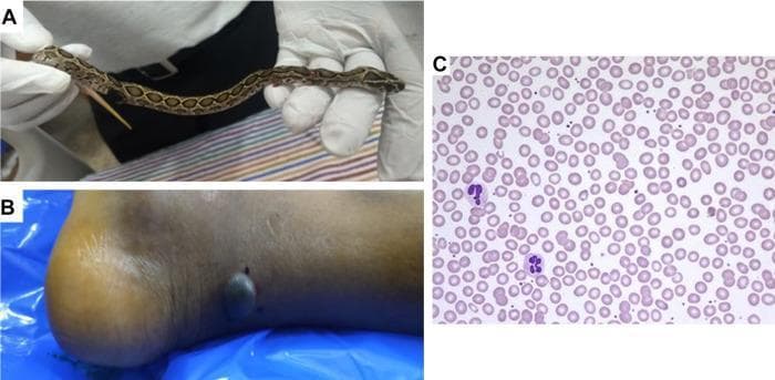 A multi-panel figure documenting a snakebite case. Panel A displays a clinical photograph of a juvenile Russell’s viper (Daboia russelii) held by gloved hands, identified by its characteristic dorsal brown blotches. Panel B is a clinical photograph of a patient's right lower leg and heel showing local envenomation effects, including a prominent dark, hemorrhagic, fluid-filled blister and two adjacent small puncture wounds consistent with fang marks. Panel C shows a diagnostic light microscopy image of a peripheral blood smear (Wright-Giemsa stain). The smear demonstrates normocytic, normochromic erythrocytes with regular morphology and no evidence of fragmentation, schistocytes, or dysmorphic red cells. Scattered multi-lobed leukocytes (neutrophils) are visible against the background of mature red blood cells. The educational focus is on the clinical presentation of viperine envenomation (local tissue destruction) and the exclusion of microangiopathic hemolytic anemia via blood film examination.