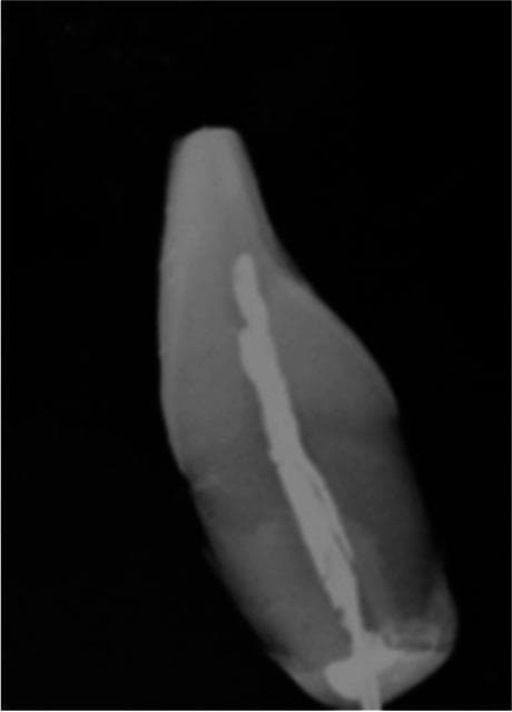 This diagnostic radiograph displays a longitudinal view of a human tooth, likely an incisor or canine, undergoing endodontic evaluation. The image illustrates the internal anatomy of the tooth, including the enamel, dentin, and a centrally located, radio-opaque material extending through the pulp chamber and into the root canal system. This dense material signifies a root canal filling or the presence of an experimental probe, such as a thermocouple used for intrapulpal temperature monitoring. The coronal portion shows a wider radiopacity where the instrument enters the pulp chamber, tapering towards the apex. Notably, the root apex appears blunted or resected, consistent with an apicoectomy or experimental preparation. The contrast between the natural tooth structure and the endodontic material provides a clear visualization of canal morphology and instrument placement. This image is relevant for dental education regarding endodontic procedures, pulp chamber anatomy, and clinical research methodologies in restorative dentistry.