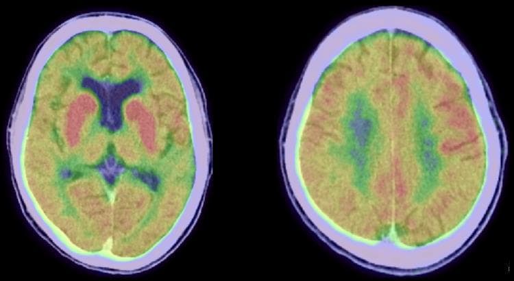 Two axial slices of an 18-Fluorodeoxyglucose Positron Emission Tomography (FDG-PET) scan of the brain demonstrating a characteristic metabolic pattern. The primary visual finding is strong, focal hypermetabolism in the bilateral basal ganglia (caudate and putamen), represented by intense red and orange color mapping. In contrast, the surrounding cerebral cortex exhibits diffuse hypometabolism, visualized through a spectrum of yellow, green, and purple shades, indicating significantly lower glucose uptake compared to the basal ganglia. These metabolic findings are indicative of neurological or autoimmune processes, such as anti-GAD antibody-associated encephalitis or chorea-related conditions, where deep gray matter structures show disproportionately high activity against a background of cortical suppression.