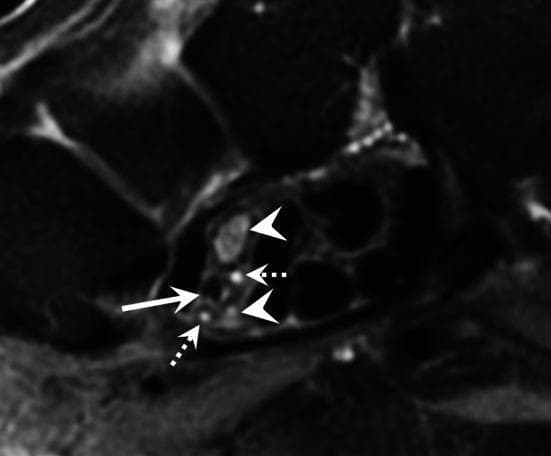 This diagnostic axial T2-weighted MRI scan depicts the cross-sectional anatomy of the carpal tunnel, focusing on anatomical variations and vascular pathology. The image highlights a bifid median nerve, represented by two distinct nerve trunks (indicated by arrowheads) instead of a single nerve bundle. Positioned between or adjacent to these nerve trunks is a persistent median artery (indicated by a straight solid arrow) which is occluded. The occlusion is evidenced by the absence of a normal vascular flow void and altered intraluminal signal intensity on this T2-weighted sequence. Additionally, small satellite veins of the median artery are visible as tiny, hyperintense circular structures (indicated by dotted arrows). This clinical finding is significant in the context of carpal tunnel syndrome, as both the bifid nerve variation and the presence of a persistent median artery (especially when thrombosed or aneurysmal) can increase the volume of contents within the carpal tunnel, potentially leading to median nerve compression.