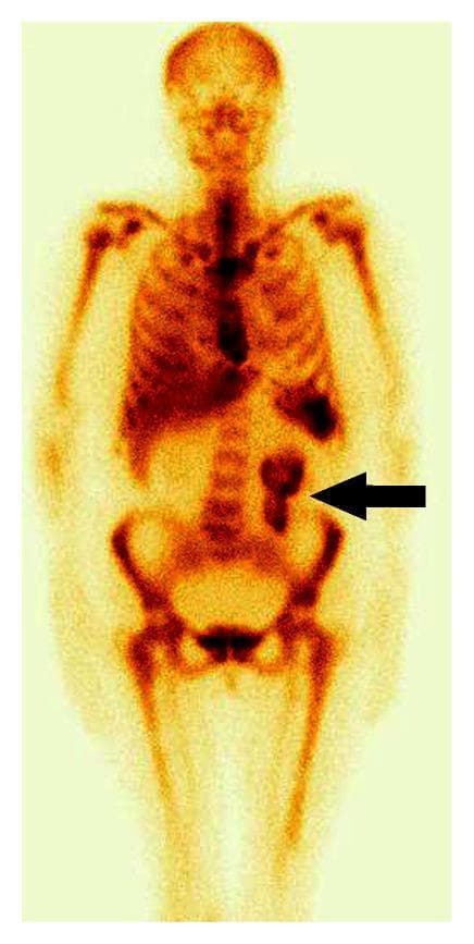 This diagnostic image is an anterior view of a whole-body scintigraphy scan performed on a 57-year-old female using 99mTc-labeled sulesomab (antigranulocyte monoclonal antibodies) to investigate fever of unknown origin. The scan demonstrates a normal physiological distribution of the radiotracer within the skeletal system, particularly in the axial skeleton, representing expected bone marrow activity. A prominent, localized pathological finding is visible in the lower abdomen: an area of intense radiotracer uptake (indicated by a black arrowhead) localized to the region of the ileum. This focal accumulation of granulocytes is highly suggestive of active inflammation, specifically characteristic of Crohn's disease in this clinical context. The scan provides essential diagnostic information by localizing inflammation to the distal small bowel when other clinical signs like abdominal pain are absent.