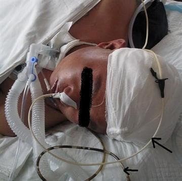 This clinical photograph illustrates a patient in a critical care setting receiving dual enteral access and mechanical ventilation. The image demonstrates the simultaneous management of gastrointestinal decompression and nutritional support. A nasogastric (NG) tube is visible, indicated by a short arrow, which contains dark-colored fluid, signifying active gastric drainage or decompression. Positioned superiorly, a nasointestinal (NI) tube, likely a naso-jejunal tube indicated by a long arrow, is secured to the patient's head bandage with a clip for the delivery of enteral nutrition. This setup is typical for patients with stress ulceration or gastric motility issues where gastric suction is required while distal intestinal feeding is maintained. Additionally, the patient is intubated with a visible endotracheal tube connected to a mechanical ventilator via white corrugated breathing circuits. The photo highlights standard procedural protocols for securing multiple nasal tubes and managing life support equipment in a complex clinical scenario, emphasizing the anatomical points of entry and the external differentiation between drainage and feeding lines.